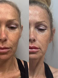 Temporalis filler final.jpg