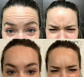 Botox+Forehead.webp