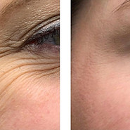 Crows feet.jpg