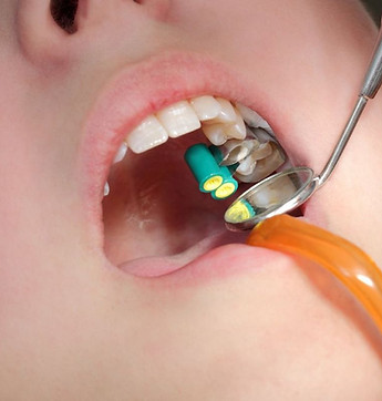 A Patient Receiving Dental Fillings