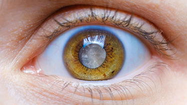 June is Cataract Awareness Month: Protect Your Sight