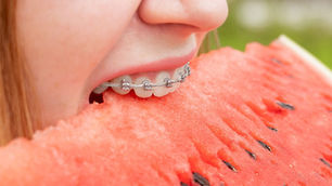 Braces-Friendly Foods: What to Eat and What to Avoid