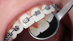 Do Wires Sometimes Break on Braces?