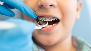 What Is the Best Age to Get Braces?