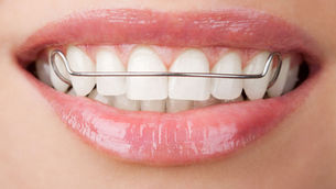 Do I Need to Wear Retainers After Braces? Here's the Honest Answer