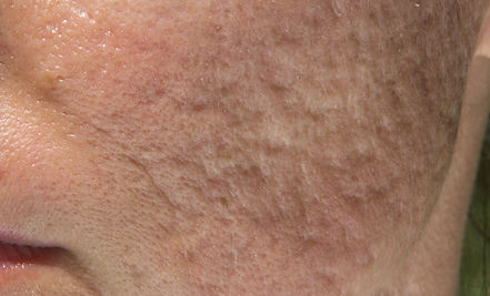 Facial Scars in Need of Laser Removal Treatments