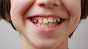 Why Did My Teeth Grow in Crooked?