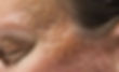 A Man With Acne Scars in Need of Scar Revising