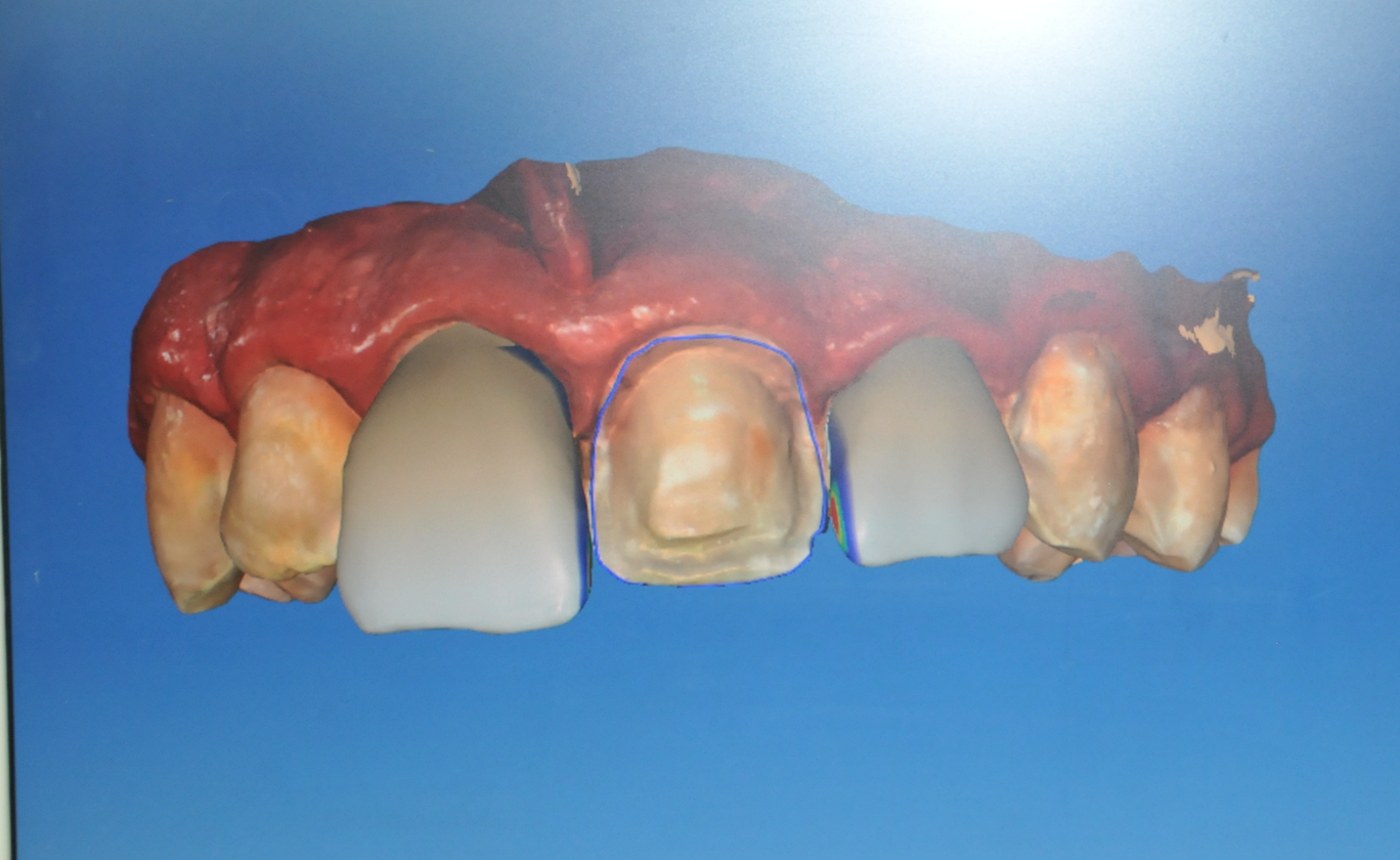 Veneers in A Day Walnutport, PA Professional Dental