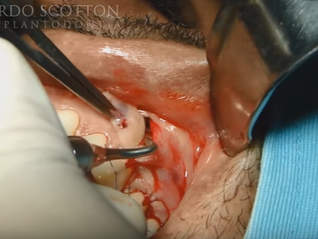 Cirurgia Plástica Gengival por Tunelização com PRF