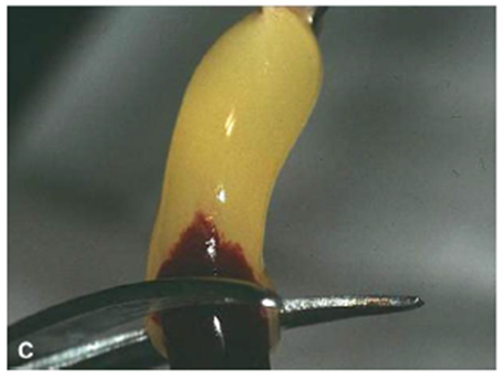 Figura retirada do trabalho: Dohan, D. M., J. Choukroun, et al. (2006). "Platelet-rich fibrin (PRF): a second-generation platelet concentrate. Part I: technological concepts and evolution." Oral Surg Oral Med Oral Pathol Oral Radiol Endod 101(3): e37-44.