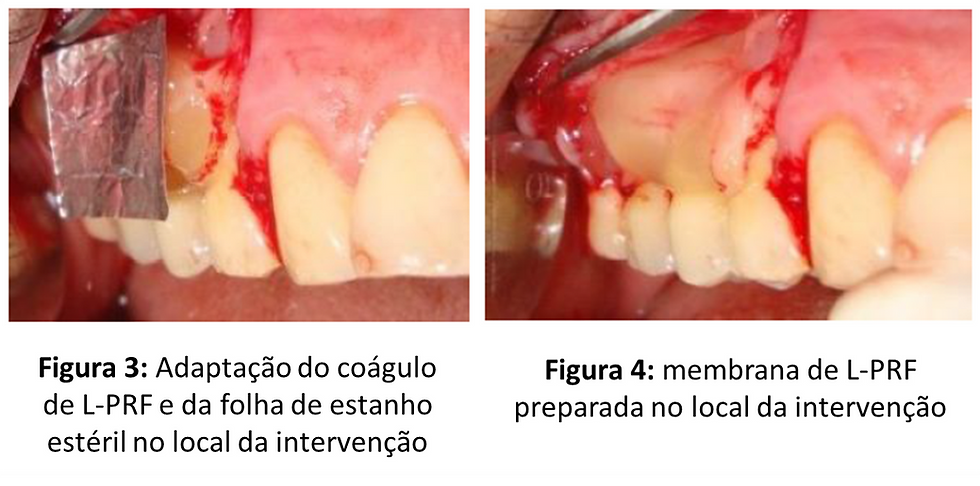 Tanya, Jadhav & Thomas, Betsy S (2012). “PLATELET RICH FIBRIN MEMBRANE FOR RECESSION COVERAGE “ e-Journal of Dentistry.
