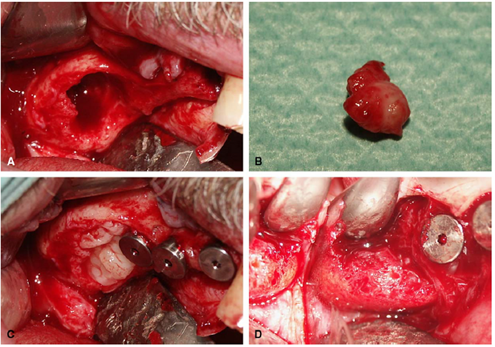 Figura retirada e modificada do trabalho: Choukroun, J., A. Diss, et al. (2006). "Platelet-rich fibrin (PRF): a second-generation platelet concentrate. Part IV: clinical effects on tissue healing." Oral Surg Oral Med Oral Pathol Oral Radiol Endod 101(3): e56-60.
