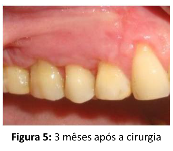 Retirada de: Tanya, Jadhav & Thomas, Betsy S (2012). “PLATELET RICH FIBRIN MEMBRANE FOR RECESSION COVERAGE “ e-Journal of Dentistry.
