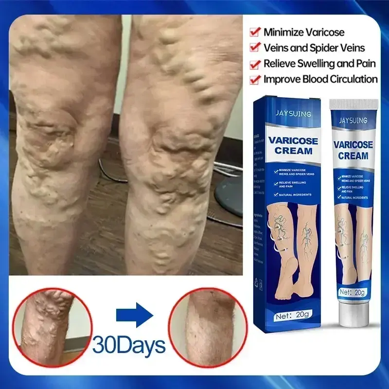 Thumbnail: NewOintment for Varicose Veins Eliminate Vasculitis Phlebitis to Relieve Spider 