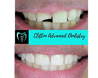 resin composite dental veneer