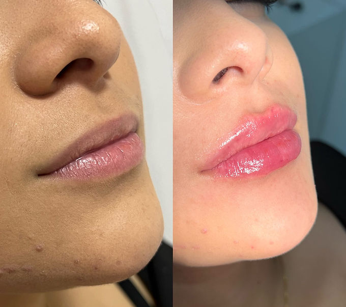 preenchimento labial