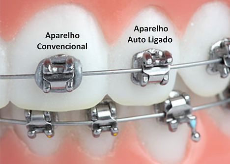 Self-ligating braces
