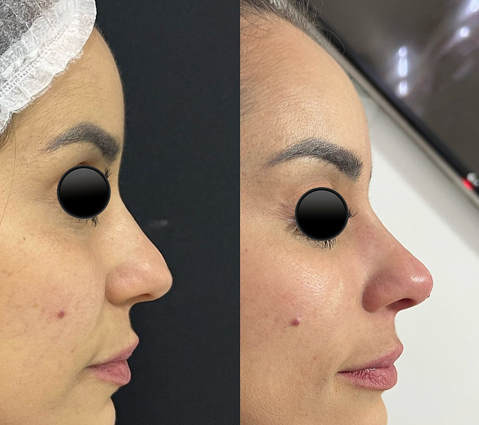 before and after facial nose harmonization