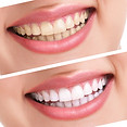 Clareamento dental antes das lentes de contato dental — Onne Odontologia