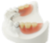 prothese dentaire dentier ppa resine stellite pas cher chirurgien dentiste