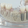 injerto oseo dental tijuana