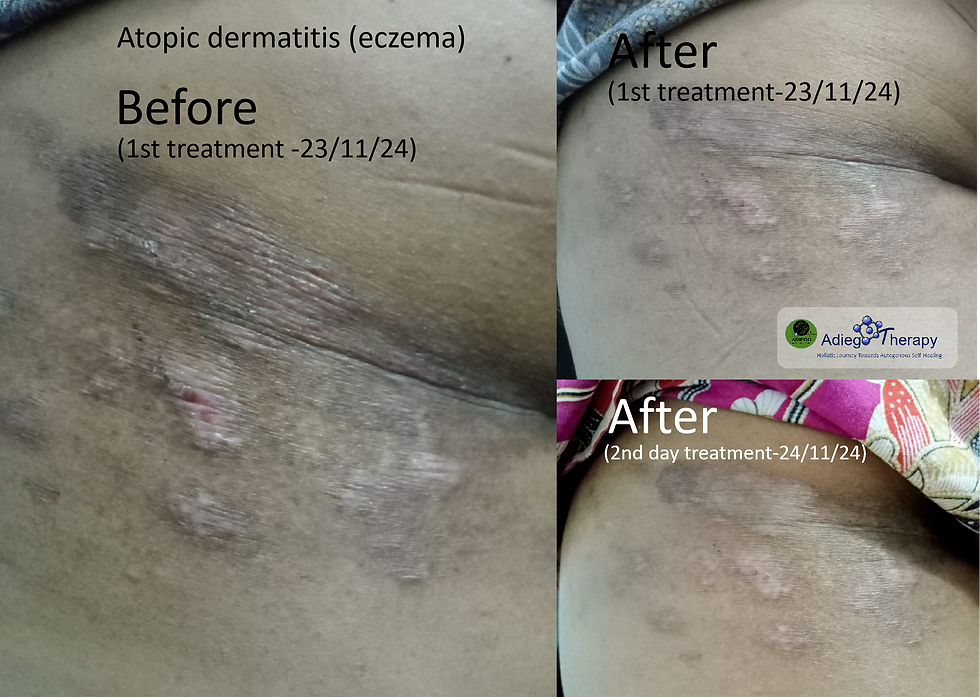 Atopic dermatitis (eczema)