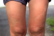 Whats-Causing-Your-Skin-Rash-04-1440x810