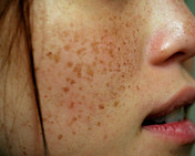 Skin-Pigmentation.jpg