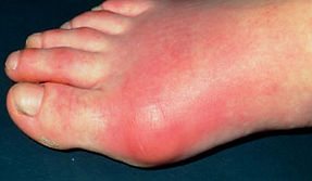 gout_300x174_M1650128.jpg