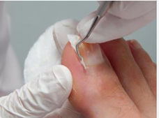 Ingegroeide nagels verwijderen