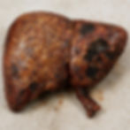 Hepatite chronique