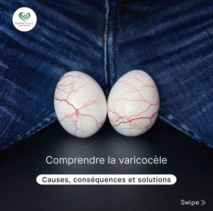 Varicocelle.