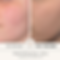 IPL Before & After Photo