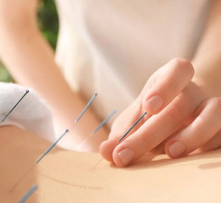 Acupuncture needles being placed