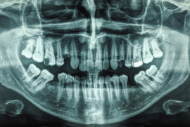 An image of an x-ray of the jaw