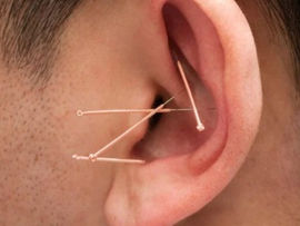 Ear with acupuncture needles