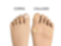 corns-calluses.jpg