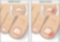 IMD_ingrown_toenail_EN.png