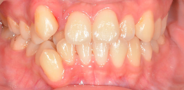 tooth_crowding