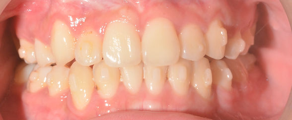 Beautiful tooth alignment after 1 and half year treatment 