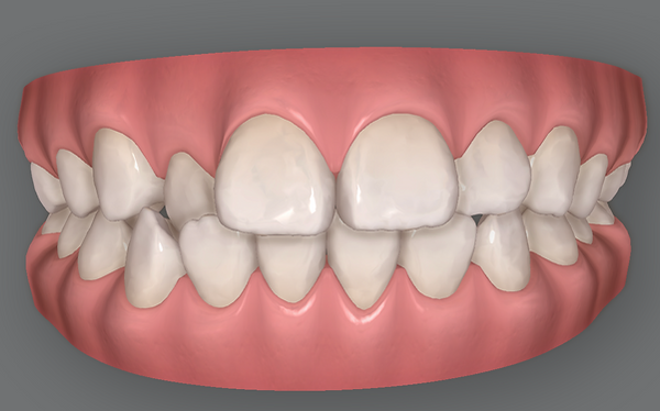 oral scan-iTero