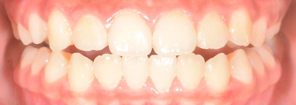 anterior cross bite post-Tx photo