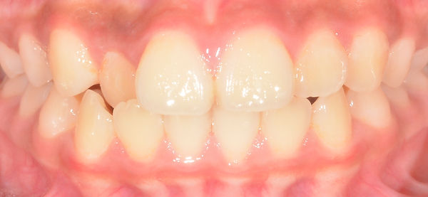 anterior cross bite