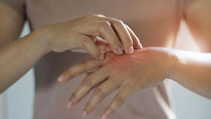 Dealing with Eczema