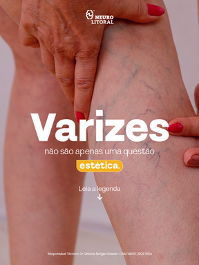 Varizes não são apenas uma questão estética.