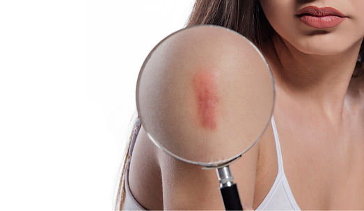 646c9813f05b61708af774dd_vecteezy_woman-having-large-hypertrophic-scar-on-her-right-upper-