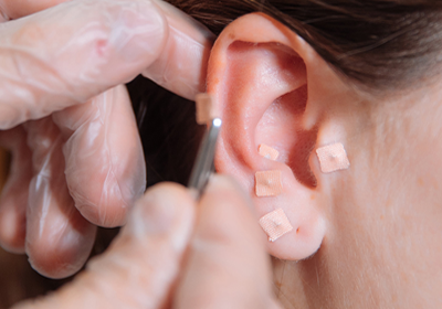 Auriculoterapia ou Acupuntura Auricular. Saiba como funciona e como pode te ajudar.