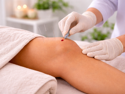 Sangria na Acupuntura: o que é, para que serve e quando é indicada.