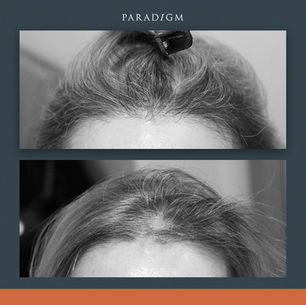 How do you repair a scar with hair transplantation?